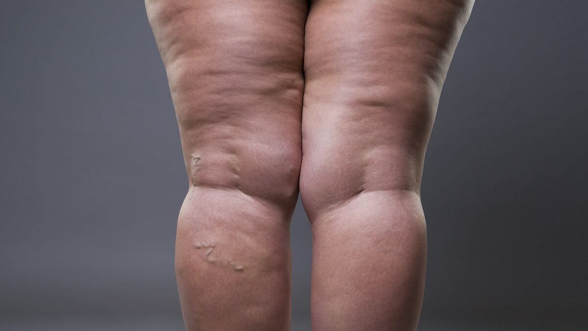Lipedema