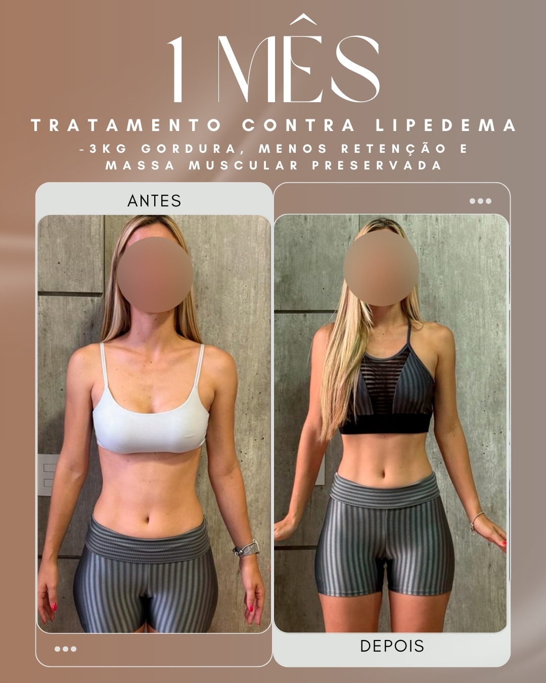 Antes e depois — Tratamento contra Lipedema